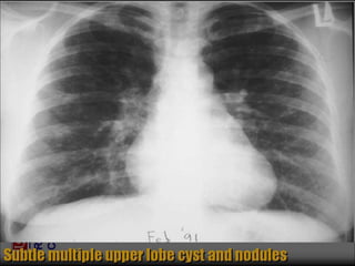 Chest Review (#1 - 76).ppt