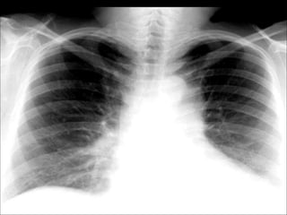 Chest Review (#1 - 76).ppt