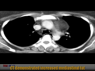Chest Review (#1 - 76).ppt
