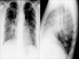 Chest Review (#1 - 76).ppt