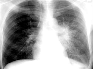 Chest Review (#1 - 76).ppt