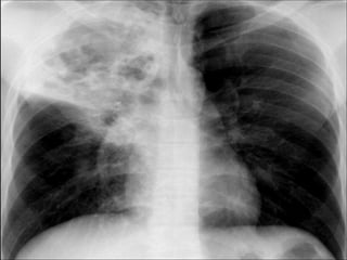 Chest Review (#1 - 76).ppt
