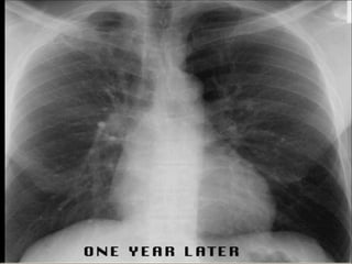 Chest Review (#1 - 76).ppt