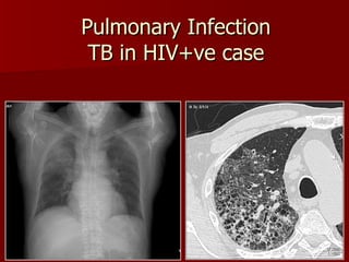 Pulmonary Infection TB in HIV+ve case 