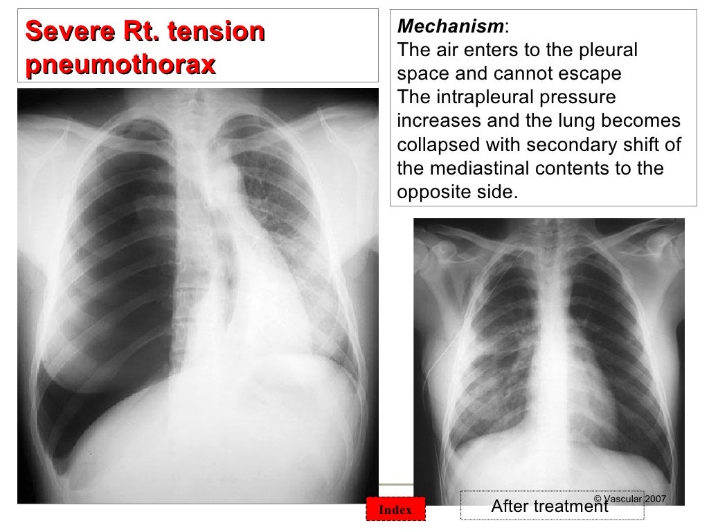 Chest surgical pathology &x rays
