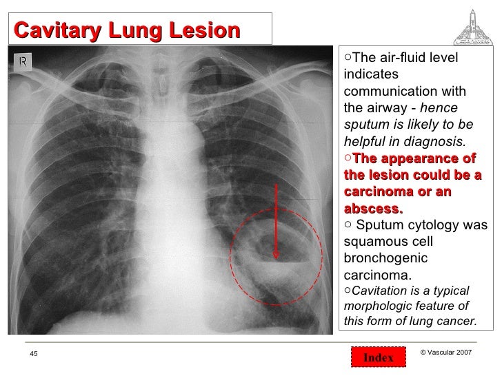 Chest surgical pathology &x rays