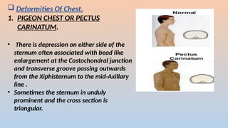 ? Deformities Of Chest.
1. PIGEON CHEST OR PECTUS
CARINATUM.
? There is depression on either side of the
sternum often associated with bead like
enlargement at the Costochondral junction
and transverse groove passing outwards
from the Xiphisternum to the mid-Axillary
line .
? Sometimes the sternum in unduly
prominent and the cross section is
triangular.
 
