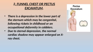2. FUNNEL CHEST OR PECTUS
EXCAVATUM.
? There is a depression in the lower part of
the sternum which may be congenital,
following rickets in childhood or an
occupational deformity in cobblers.
? Due to sternal depression, the normal
cardiac shadow may appear enlarged on X-
ray chest.
 