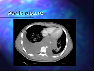 Chest Trauma | PPT
