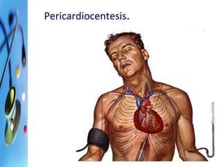Pericardiocentesis. 
 
