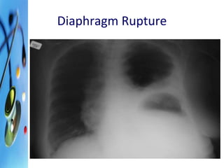 Diaphragm Rupture 
 