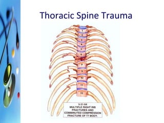 Thoracic Spine Trauma 
 