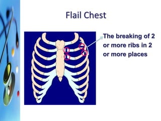 Flail Chest 
The breaking of 2 
or more ribs in 2 
or more places 
 