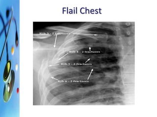 Flail Chest 
 
