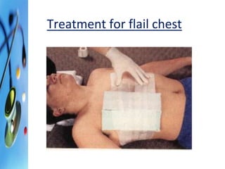 Treatment for flail chest 
 