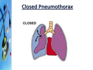 Closed Pneumothorax 
 