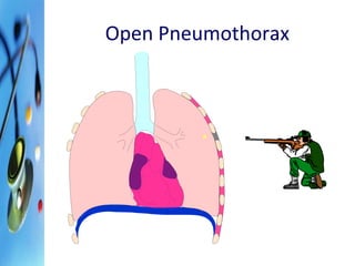 Open Pneumothorax 
 