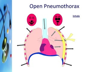 Open Pneumothorax 
Inhale 
 