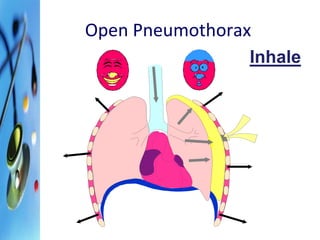 Open Pneumothorax 
Inhale 
 