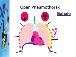 Open Pneumothorax 
Exhale 
 
