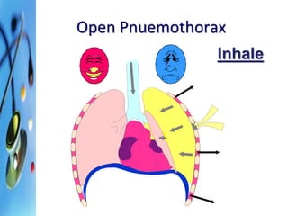 Open Pnuemothorax 
Inhale 
 