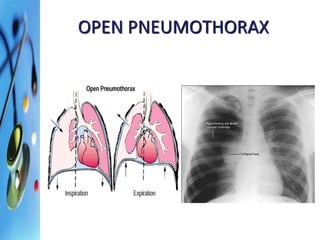 OPEN PNEUMOTHORAX 
 