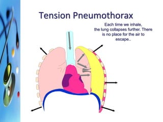 Tension Pneumothorax 
Each time we inhale, 
the lung collapses further. There 
is no place for the air to 
escape.. 
 