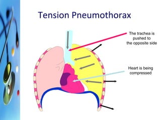 Tension Pneumothorax 
The trachea is 
pushed to 
the opposite side 
Heart is being 
compressed 
 