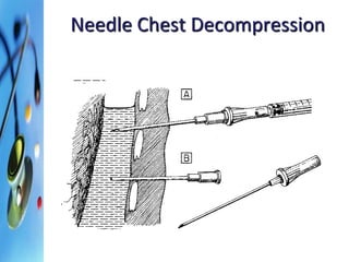 Needle Chest Decompression 
 