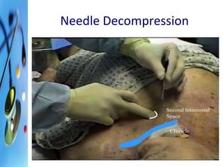 Needle Decompression 
 
