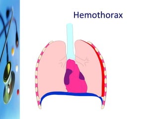 Hemothorax 
 