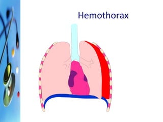 Hemothorax 
 