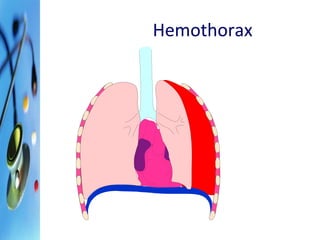 Hemothorax 
 