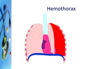 Hemothorax 
 