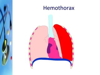 Hemothorax 
 