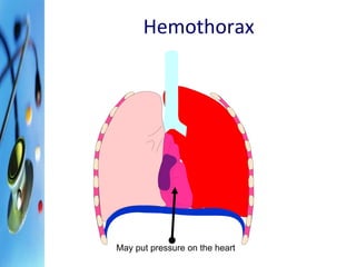Hemothorax 
May put pressure on the heart 
 