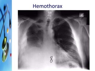 Hemothorax 
 