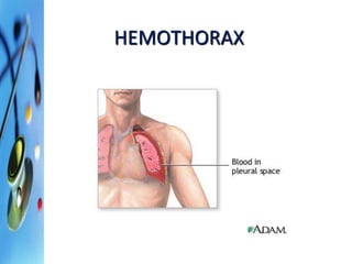 HEMOTHORAX 
 