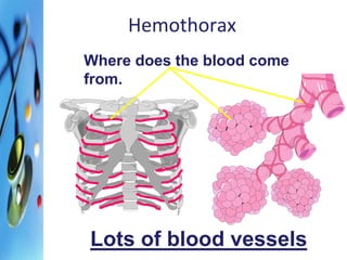 Hemothorax 
Where does the blood come 
from. 
Lots of blood vessels 
 