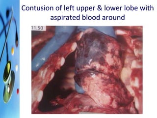 Contusion of left upper & lower lobe with 
aspirated blood around 
 
