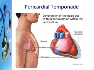 Pericardial Temponade 
 