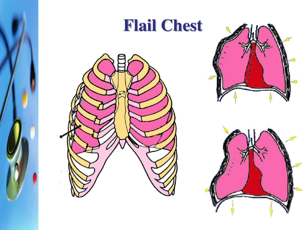 Chest trauma