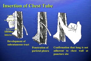 Chest trauma | PPT