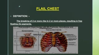 z
FLAIL CHEST
 DEFINITION: -
The breaking of 2 or more ribs In 2 or more places, resulting in free
floating rib segments.
 