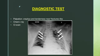 z
DIAGNOSTIC TEST
 Palpation: crepitus and tenderness near fractures ribs
 Chest x ray
 Ct scan
 