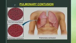 z PULMONARY CONTUSION
 