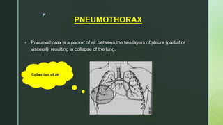 z
PNEUMOTHORAX
 Pneumothorax is a pocket of air between the two layers of pleura (partial or
visceral), resulting in collapse of the lung.
Collection of air
 