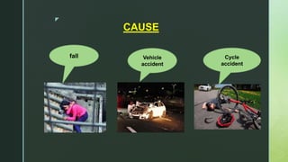 z
CAUSE
fall Vehicle
accident
Cycle
accident
 