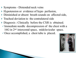 Symptoms - Distended neck veins
 Hypotension or evidence of hypo perfusion,
 Diminished or absent breath sounds on affected side,
 Tracheal deviation to the contralateral side
 Diagnosis : Clinically before the CXR is obtained.
 Immediate needle decompression of the chest with a
16G in 2nd intercostal space, midclavicular space.
 Once accomplished, a chest tube is placed.
 