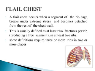A flail chest occurs when a segment of the rib cage
breaks under extreme stress and becomes detached
from the rest of the chest wall.
This is usually defined as at least two fractures per rib
(producing a free segment), in at least two ribs.
some definitions require three or more ribs in two or
more places
 